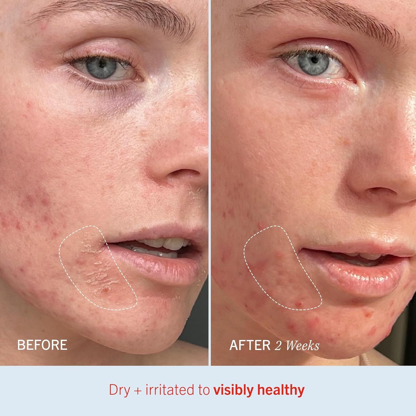 Ultra Repair Cream Intensive Hydration Daily Moisturiser for Face + Body – Strengthens Skin Barrier + Instantly Relieves Dry, Distressed Skin – 170.1 G + Bonus 28.3 G Travel Size