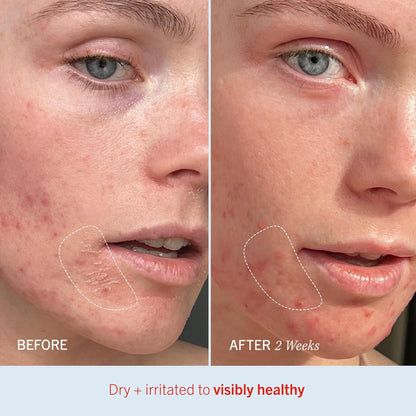 Ultra Repair Cream Intensive Hydration Daily Moisturiser for Face + Body – Strengthens Skin Barrier + Instantly Relieves Dry, Distressed Skin – 170.1 G + Bonus 28.3 G Travel Size